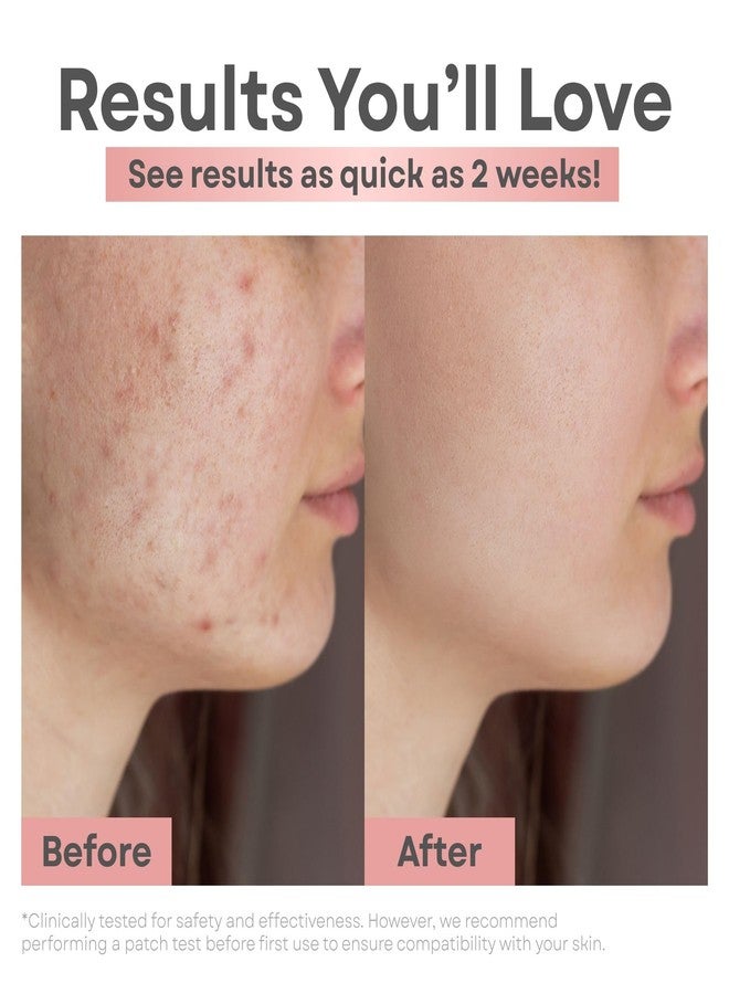 كلير إسينس غسول الوجه Clear Essence Platinum للتحكم في الشوائب، تركيبة مثالية لحب الشباب، 5 أونصات، منظف للوجه للبشرة الدهنية، مناسب لحب الشباب والشوائب، منظف رغوي لطيف لحب الشباب للمراهقين والنساء والرجال، حل يومي للعناية بالبشرة - Image 3
